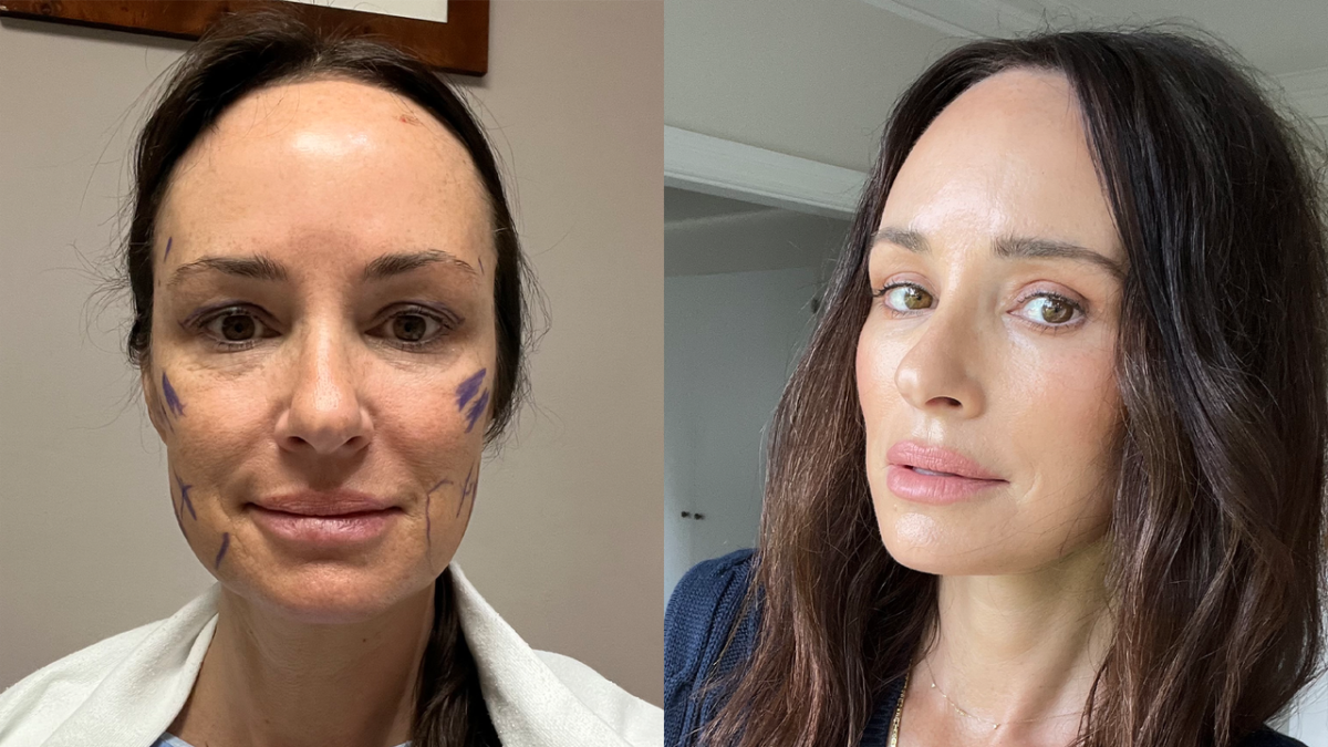 Catt Sadler Got a Facelift, a Neck Lift, and an Eye Lift at 48. She Doesn’t Care What You Think About That