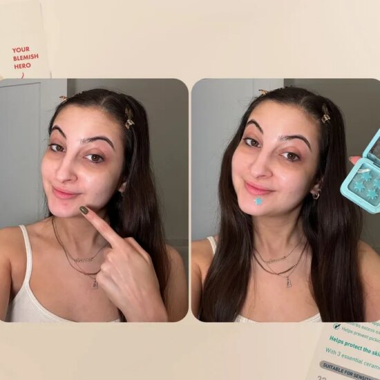 6 Best Pimple Patches for Every Breakout 2026, Tested & Reviewed